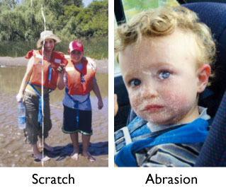Scratch vs. Abrasion